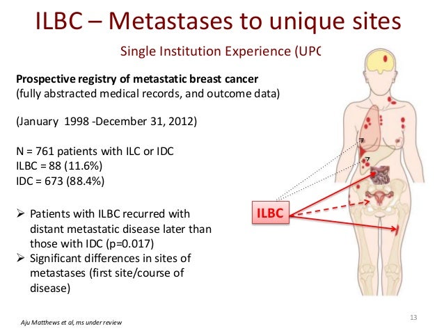 lobular carcinoma breast cancer Lobular carcinoma breast cancer